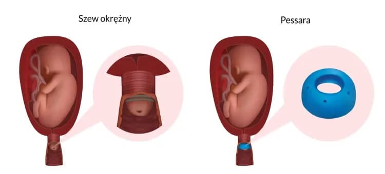 Skracanie szyjki macicy objawy – co powinno Cię zaniepokoić?